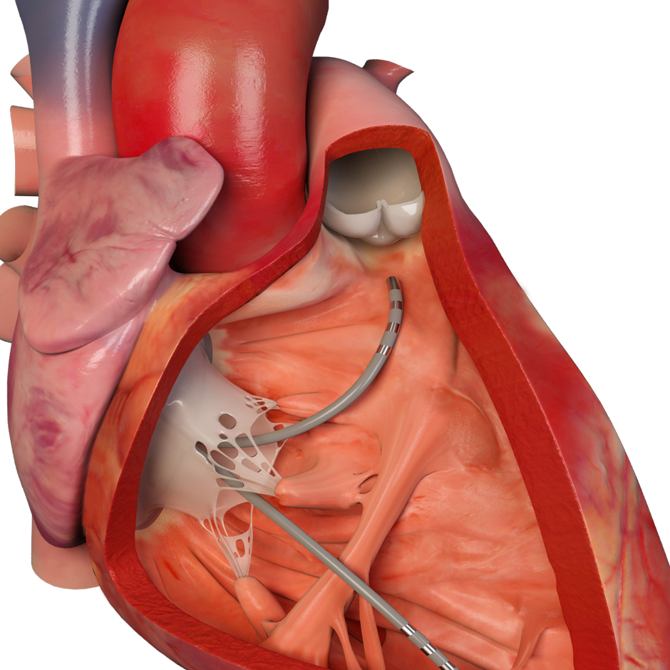 BLAZER PRIME™ Temperature Ablation Catheter - Boston Scientific